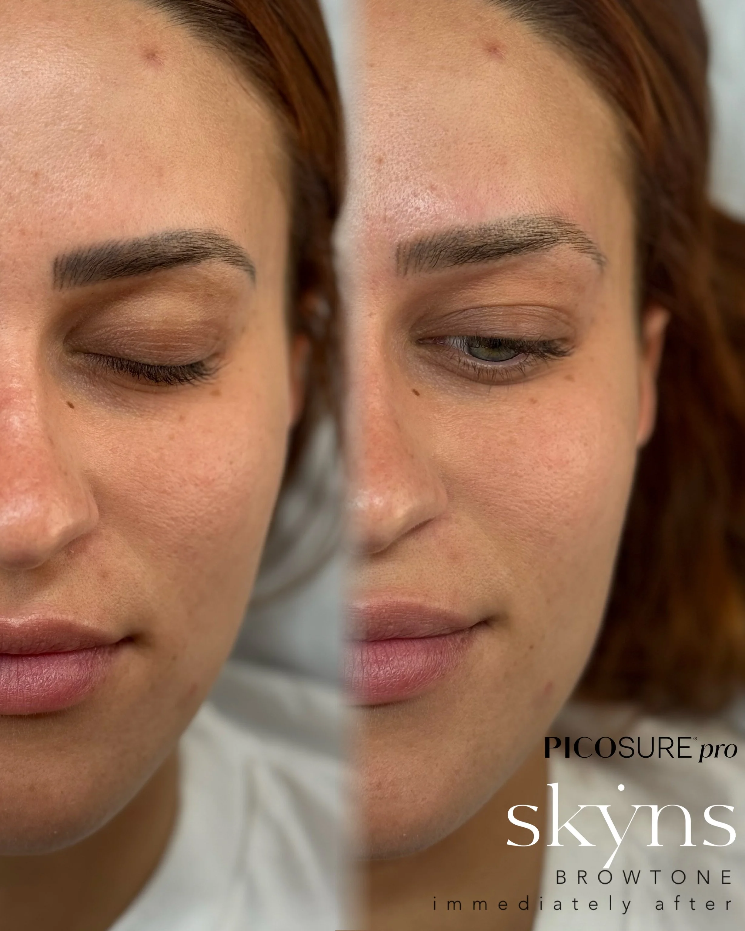 picosure-pro-cosmetic-tattoo-removal-treatment-8