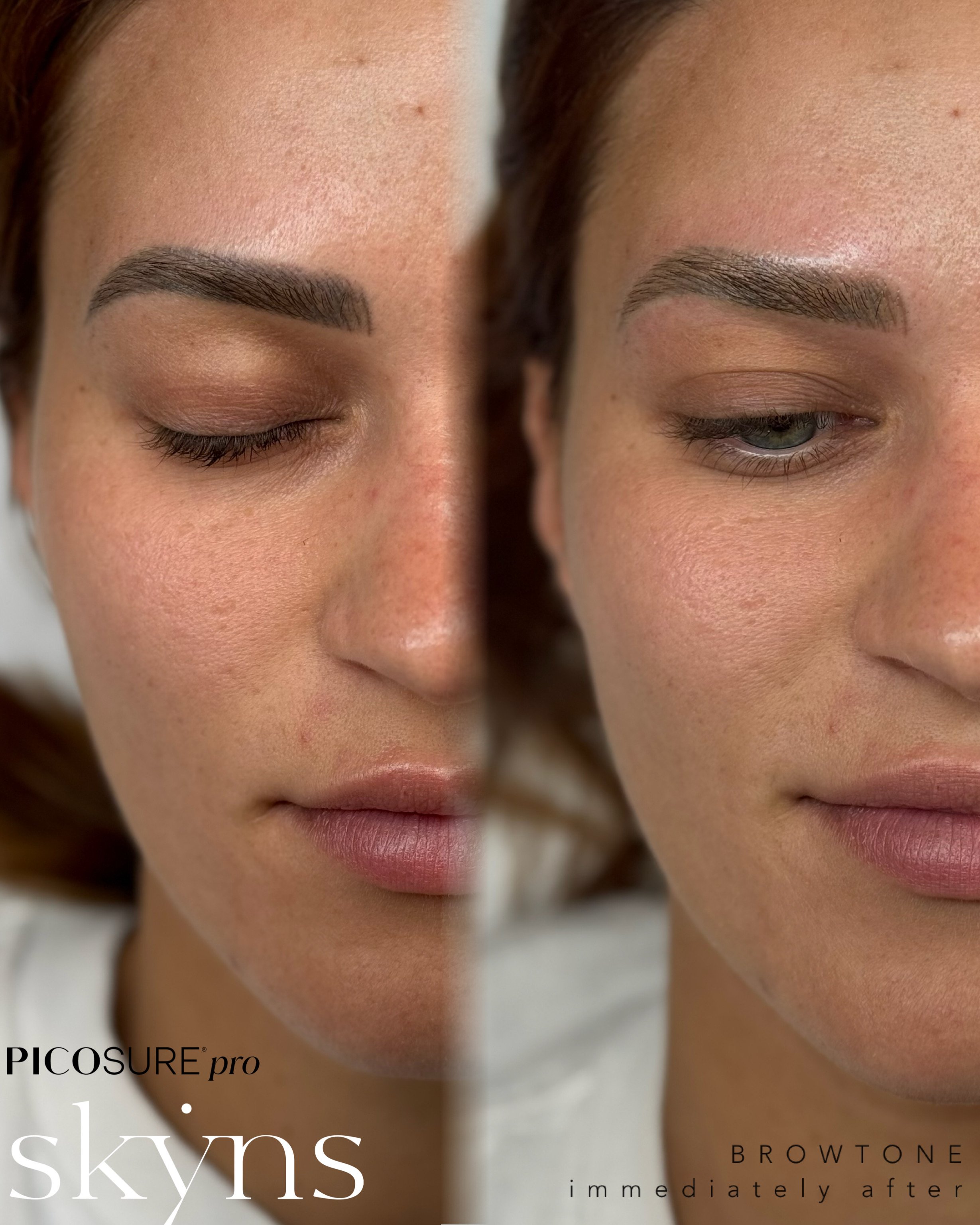 picosure-pro-cosmetic-tattoo-removal-treatment-9
