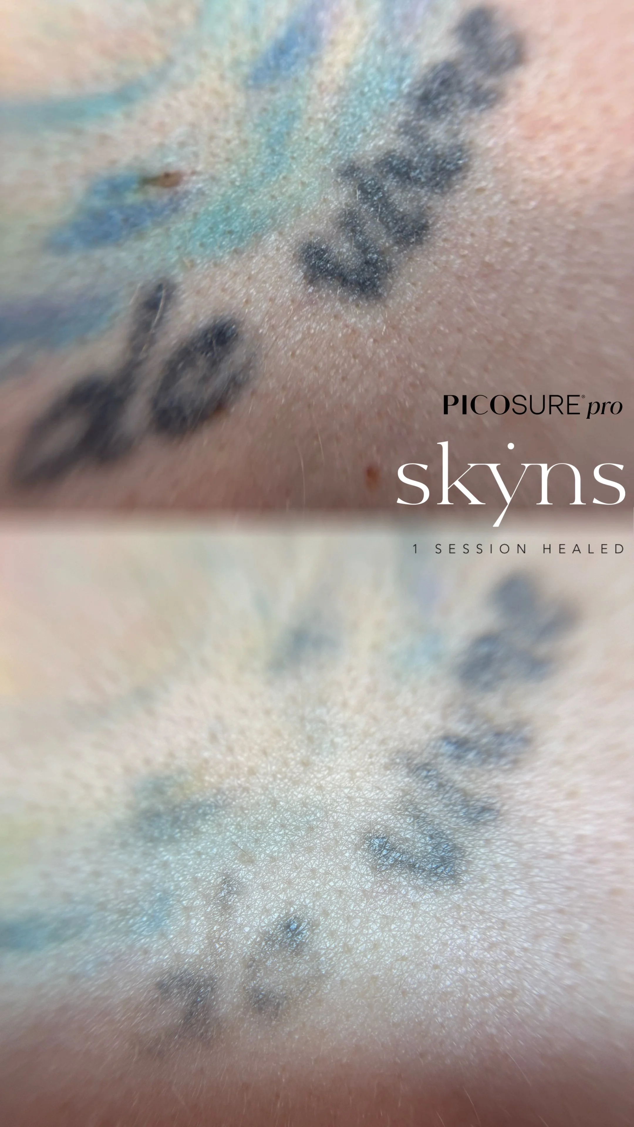 picosure-pro-body-tattoo-removal-treatment-1