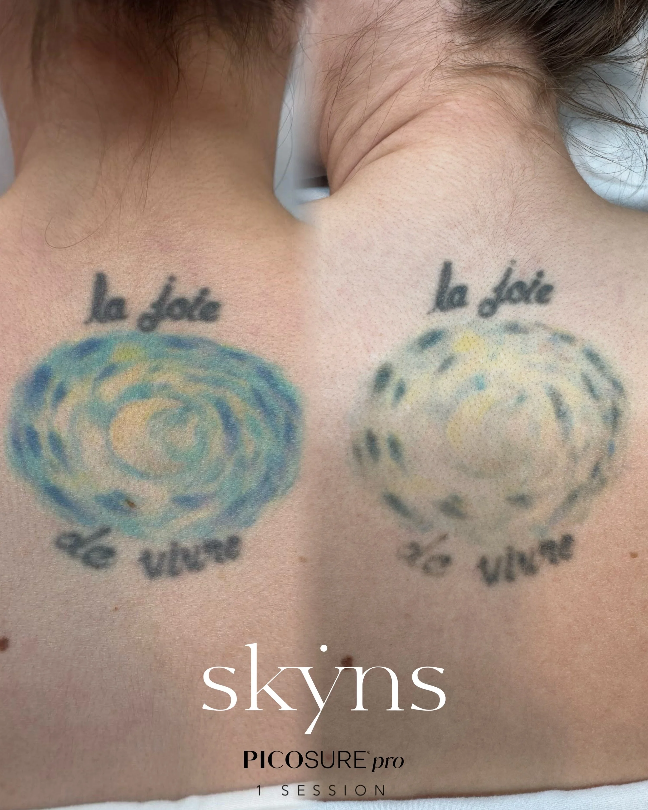 picosure-pro-body-tattoo-removal-treatment-2