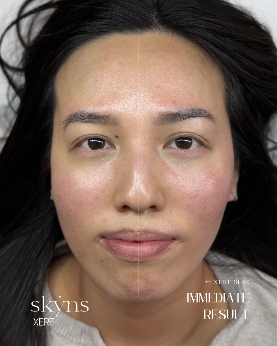 XERF structural skin tightening treatment demonstrating natural facial support.
