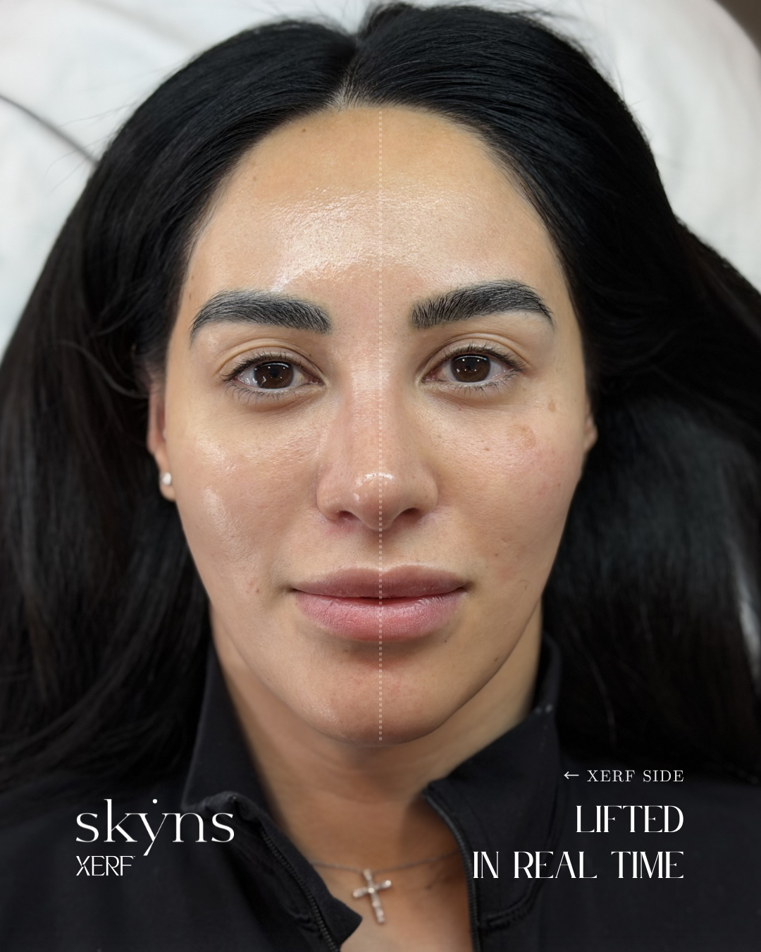 XERF structural skin tightening results