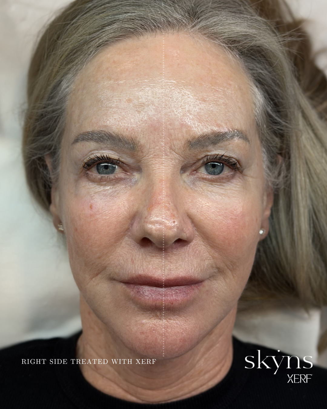 xerf-calgary-before-after-half-face-21.png