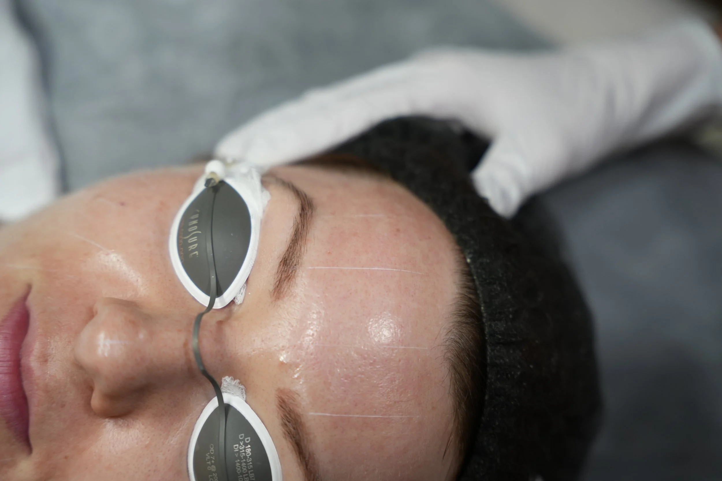 3.Skyns Skin Rejuvenation Treatment Calgary.JPG