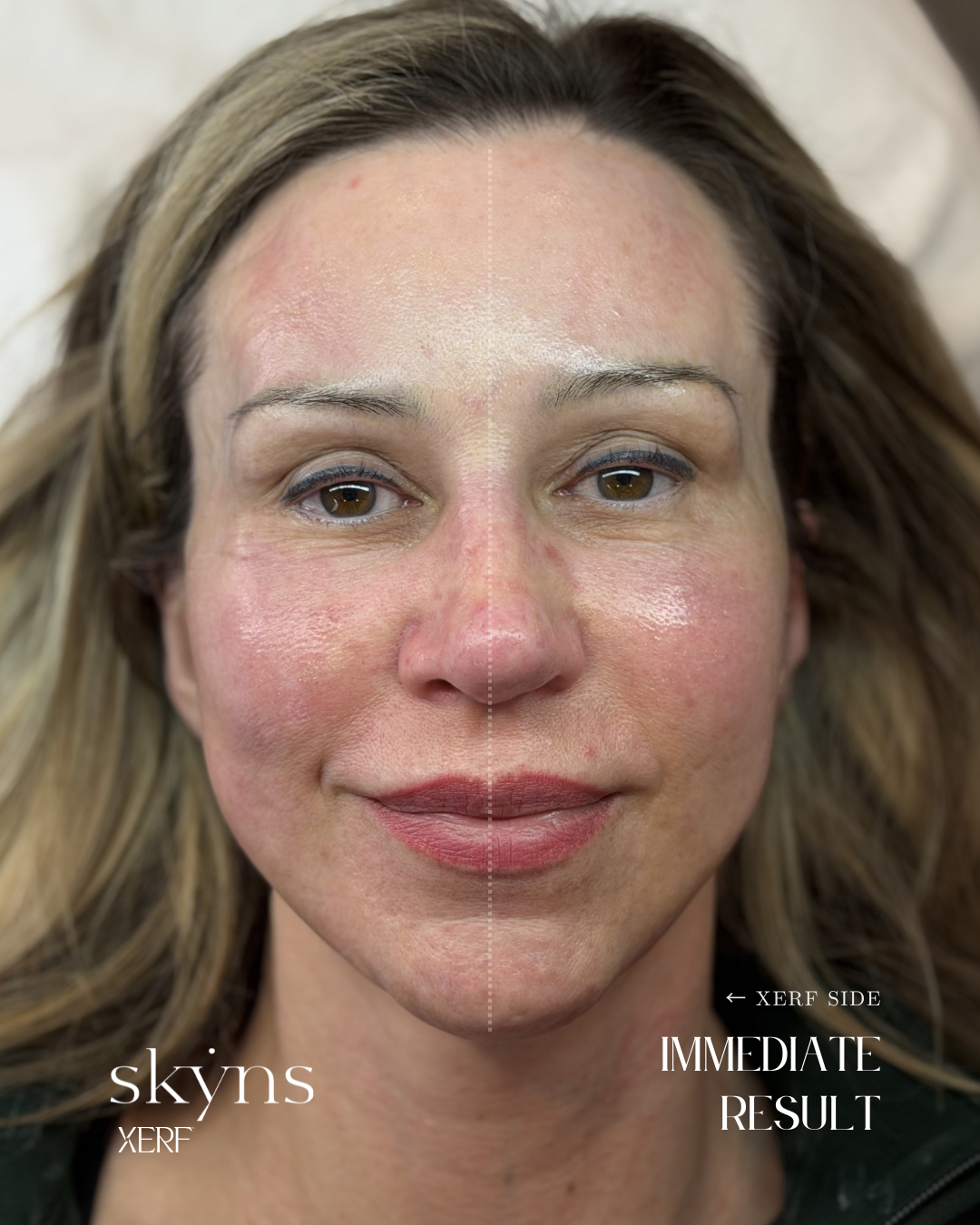 Clinical image of a real patient following XERF structural skin tightening treatment.