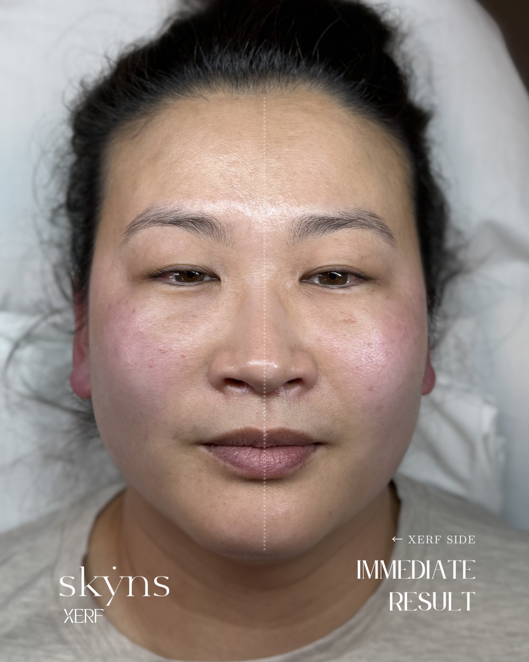 Immediate structural skin tightening response with XERF treatment.