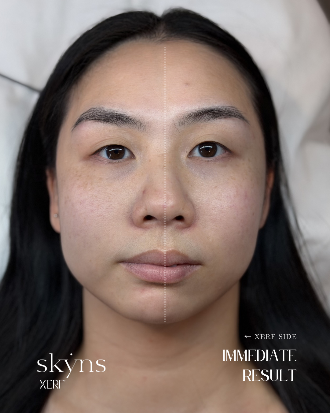 Real patient immediately following XERF structural skin tightening treatment.