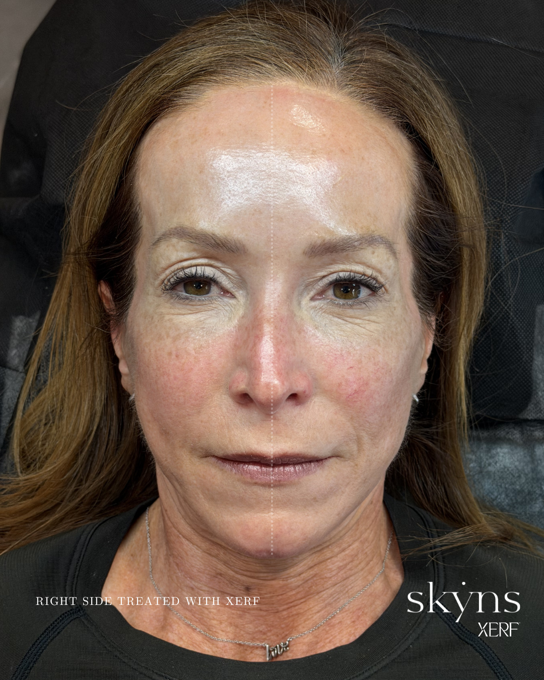 xerf-calgary-before-after-half-face-1.png
