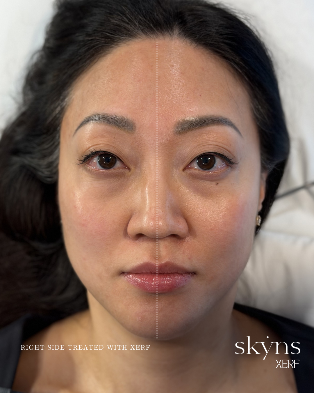 xerf-calgary-before-after-half-face-12.png