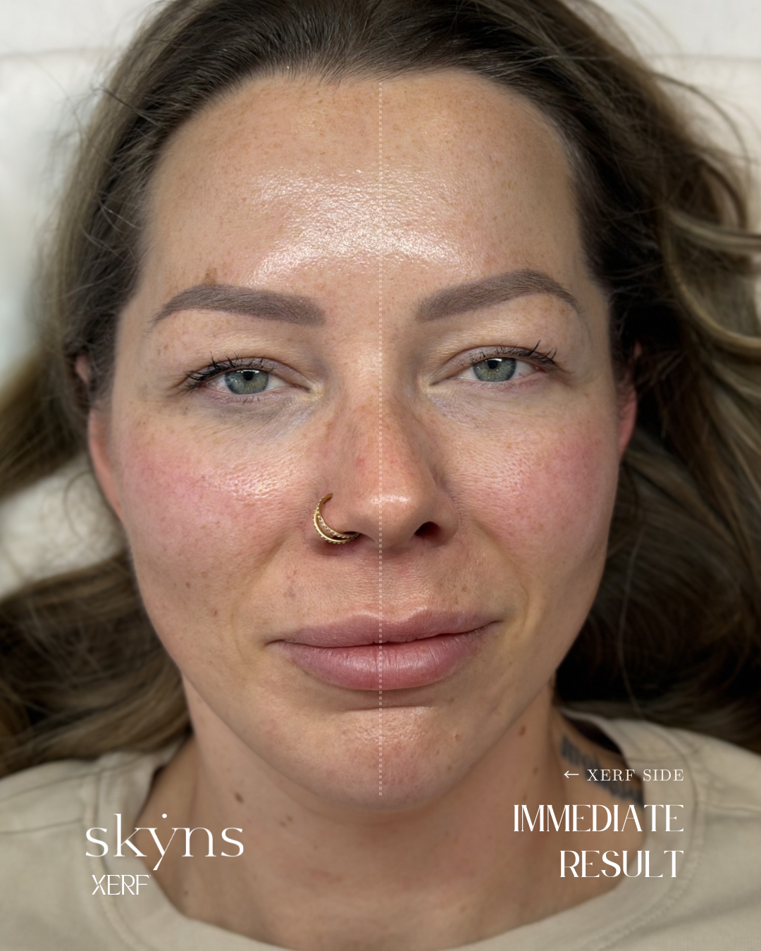 Real patient result following XERF structural skin tightening. Individual results vary.