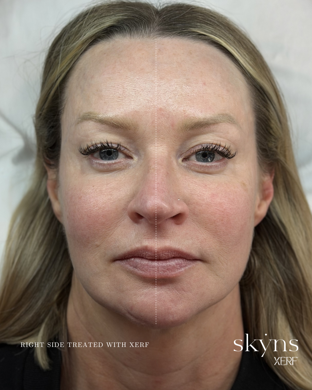 xerf-calgary-before-after-half-face-31.png