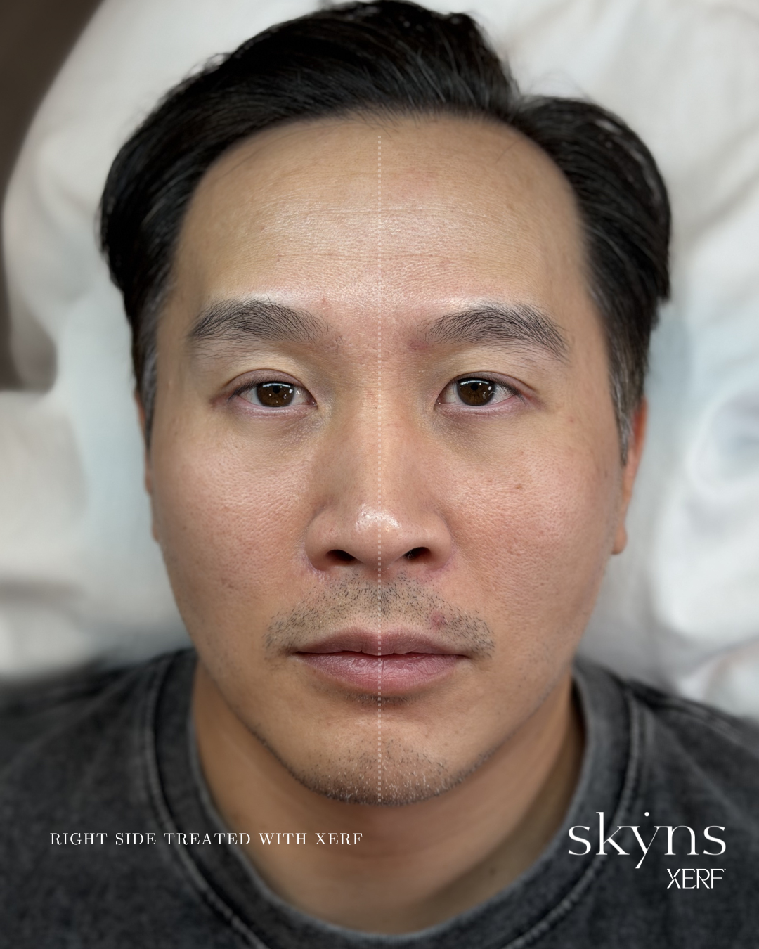 xerf-calgary-before-after-half-face-7.png