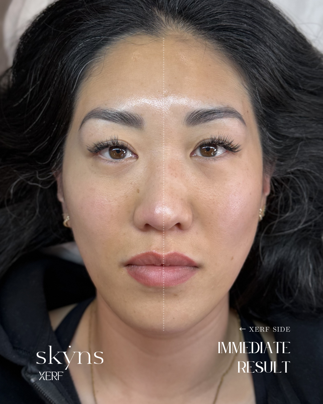 Immediate clinical response following XERF structural skin tightening treatment.
