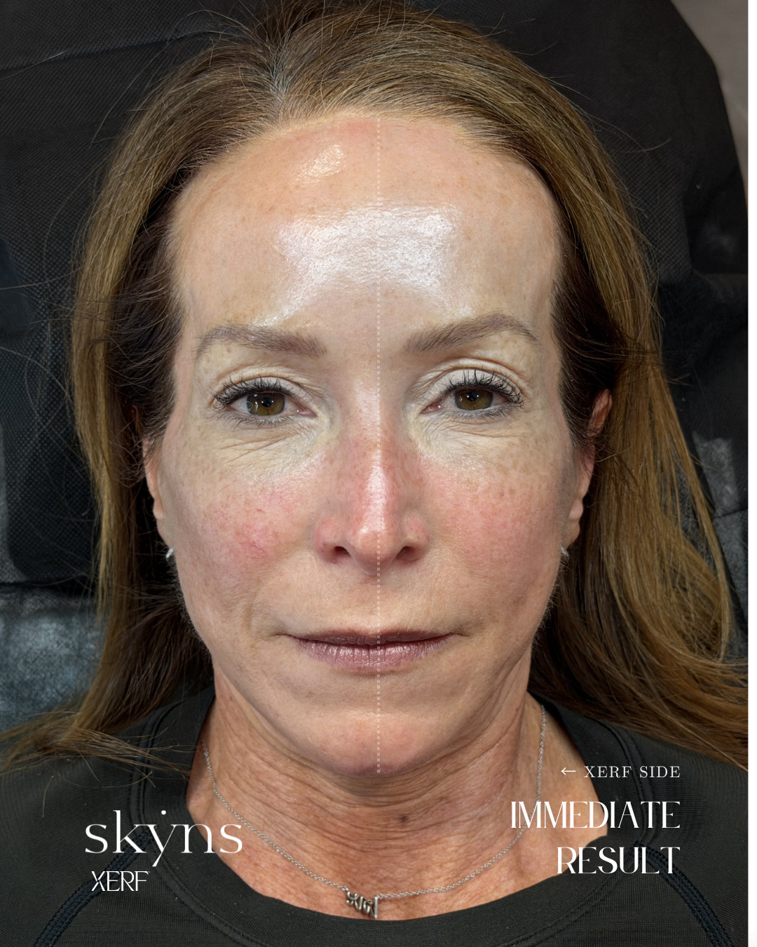 Real patient XERF structural skin tightening treatment showing the immediate treatment response. Individual results vary.