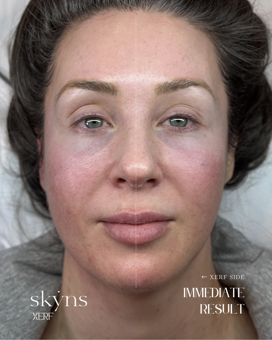 XERF treatment supporting facial contours and skin structure.