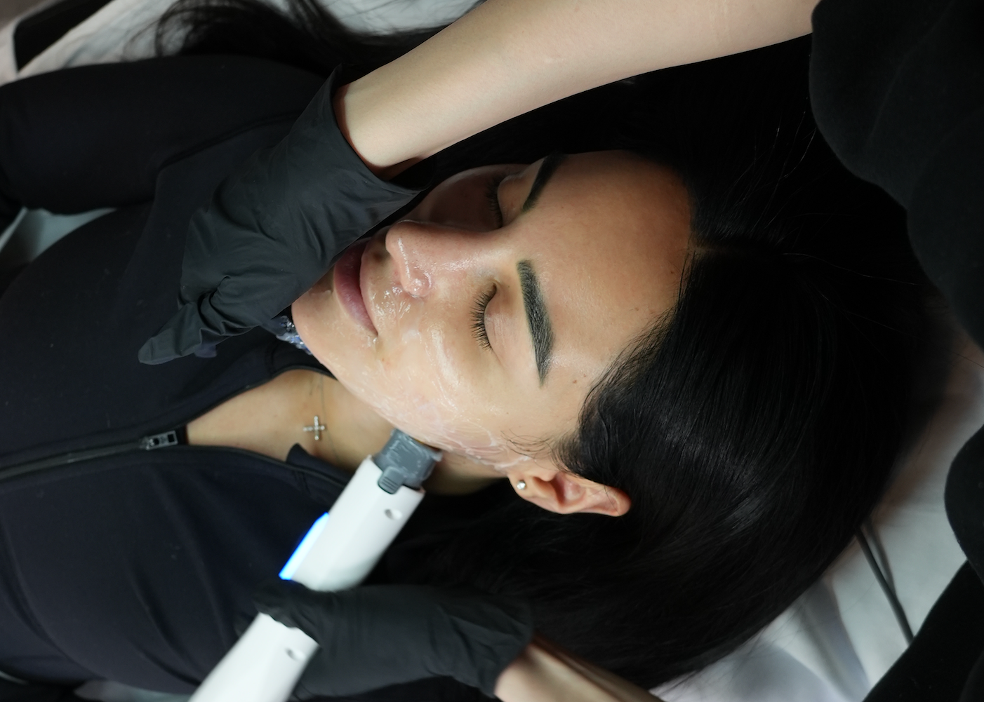 XERF neck treatment