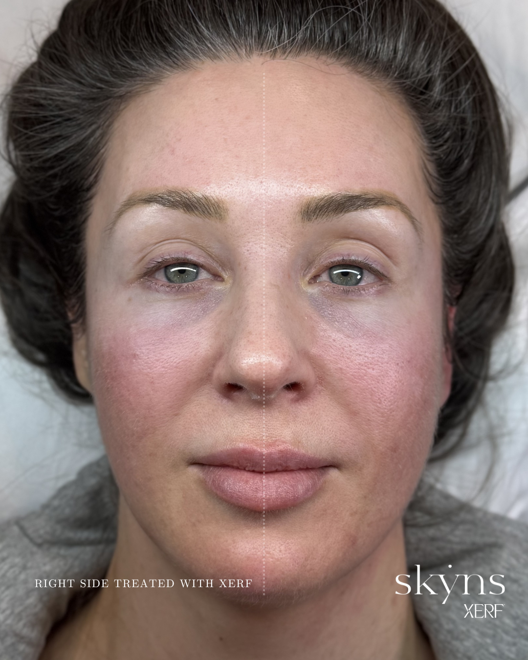 xerf-calgary-before-after-half-face-28.png