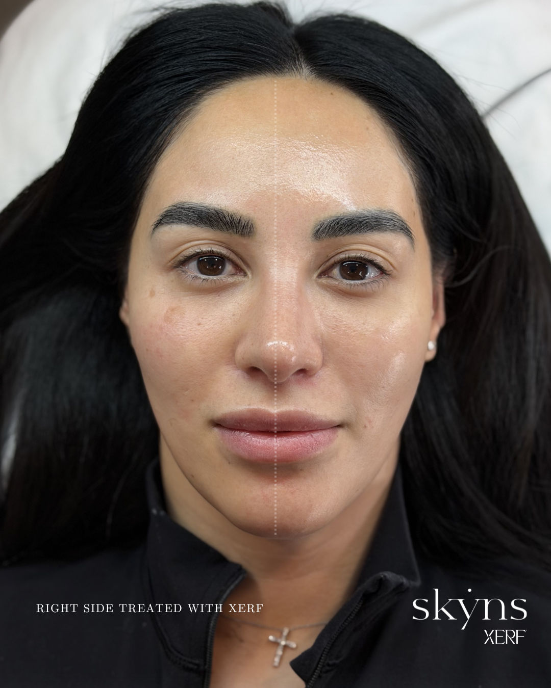 xerf-calgary-before-after-half-face-9.png