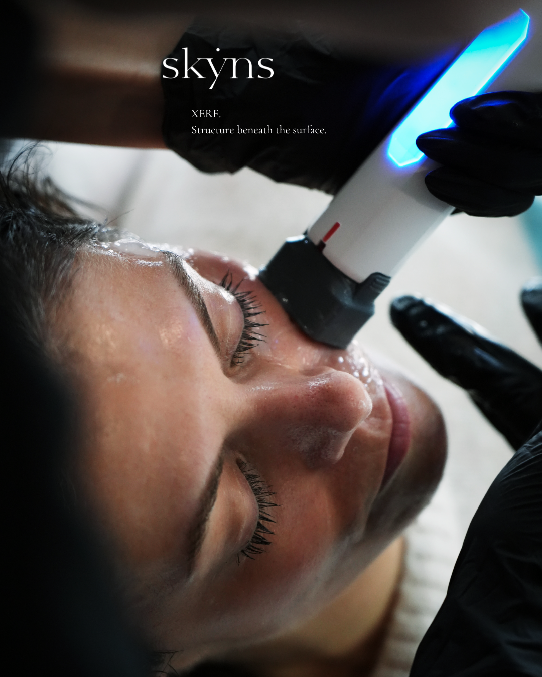 Client receiving a XERF structural radiofrequency skin tightening treatment at SKYNS laser and skin clinic in Calgary.