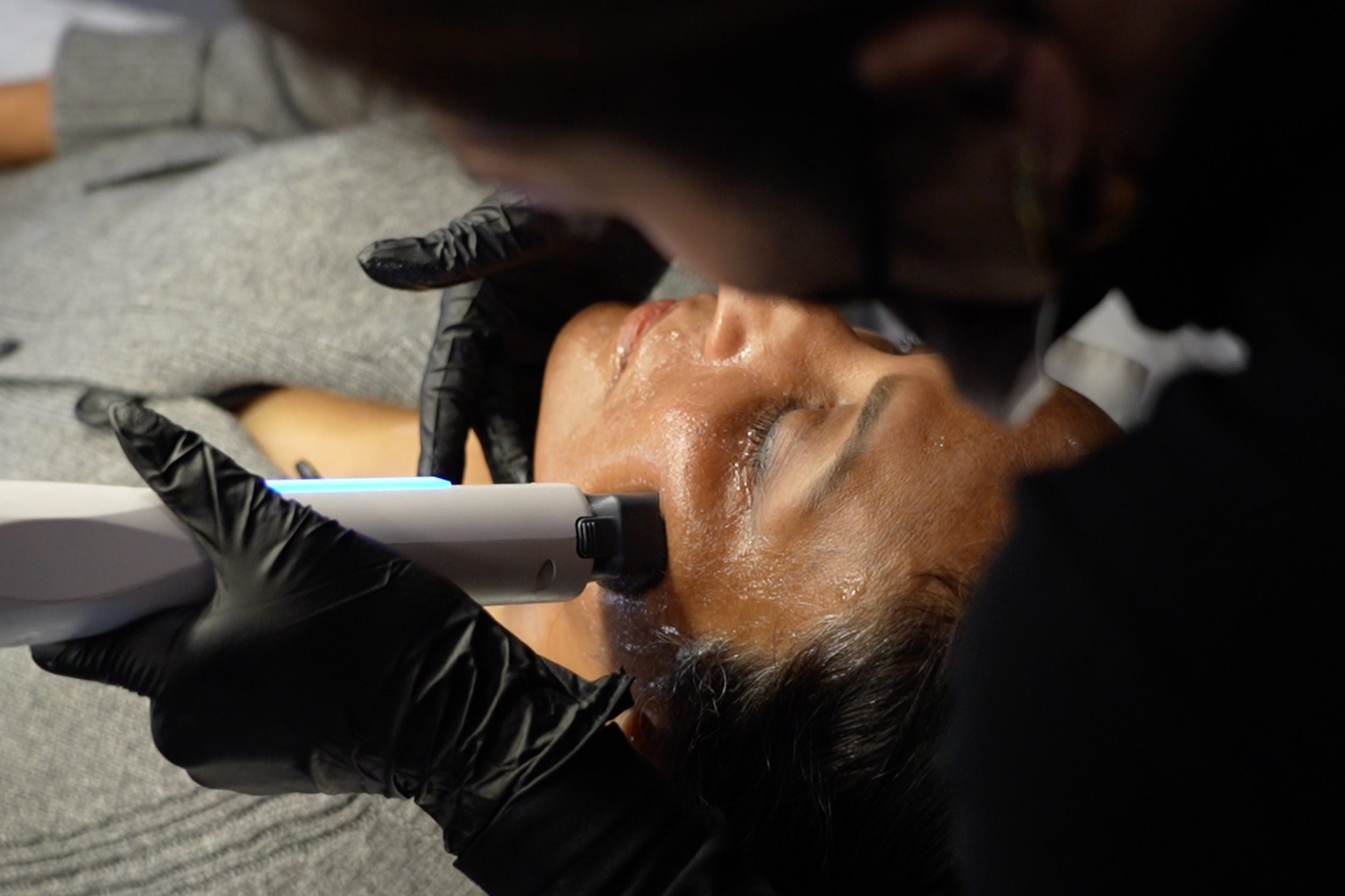 XERF mid face treatment