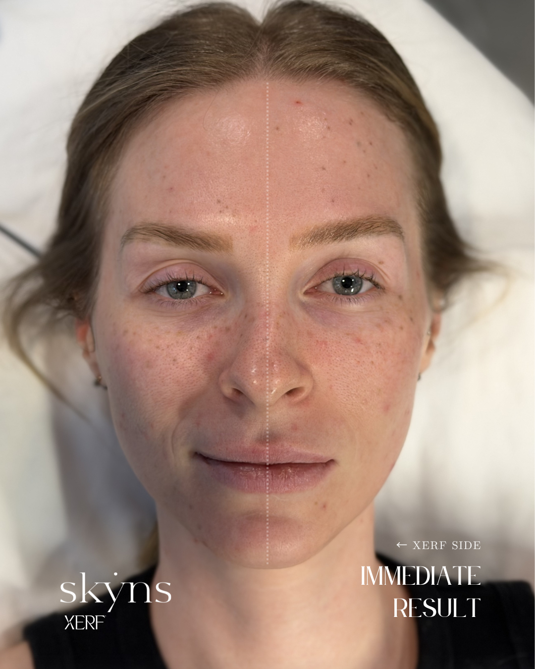 Half-face XERF treatment highlighting the immediate structural skin tightening response.