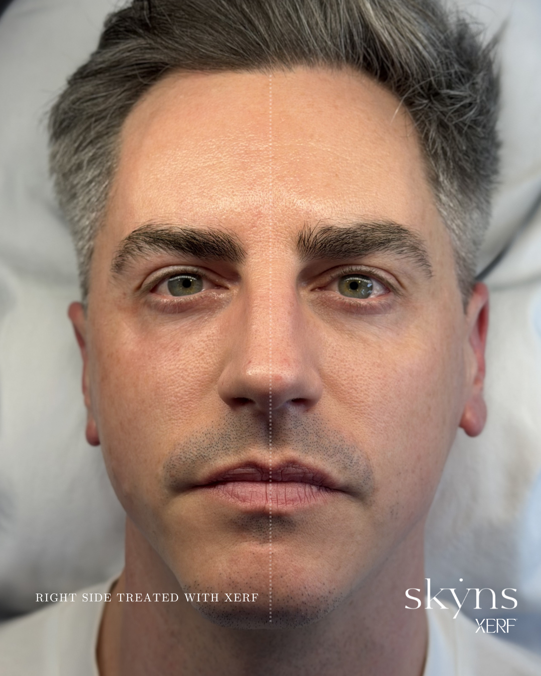 xerf-calgary-before-after-half-face-22.png