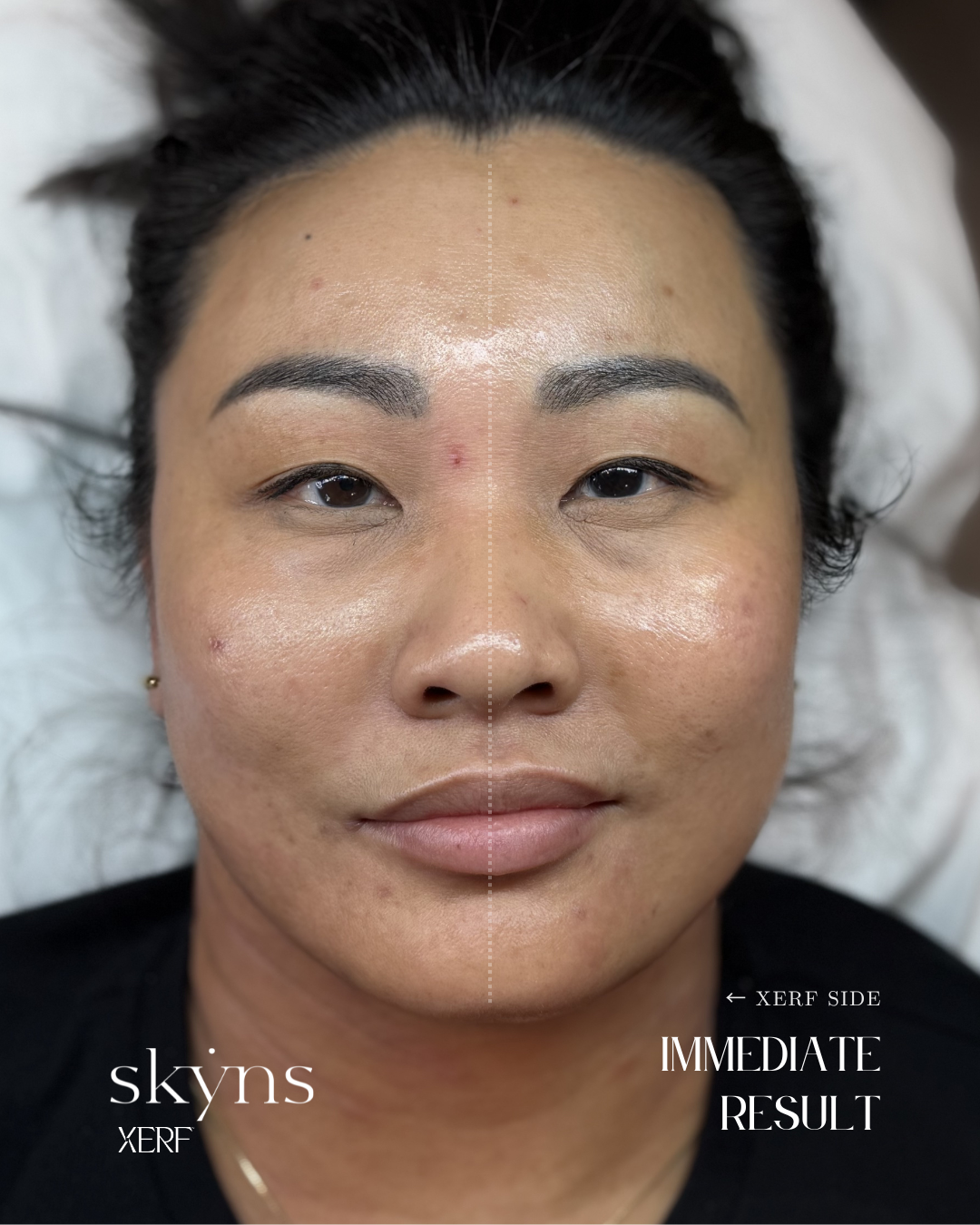 Clinical result immediately after XERF structural skin tightening treatment.