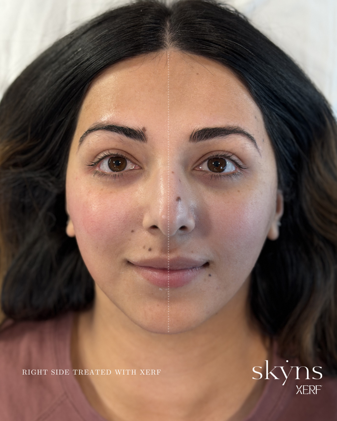 xerf-calgary-before-after-half-face-13.png