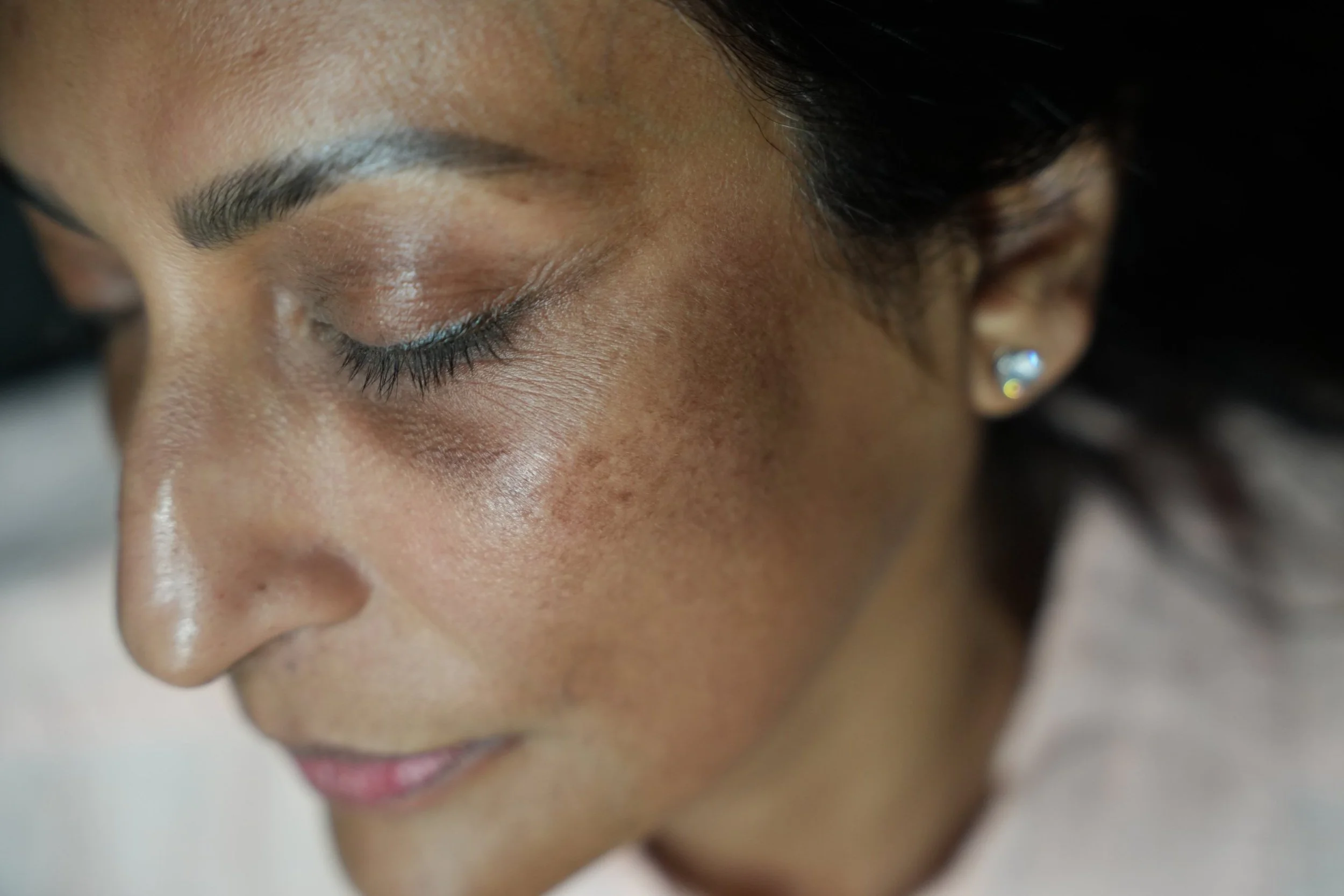 PicoSure Pro skin texture treatment