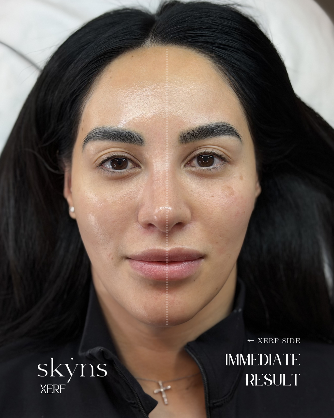 Half-face XERF treatment demonstrating immediate structural support.
