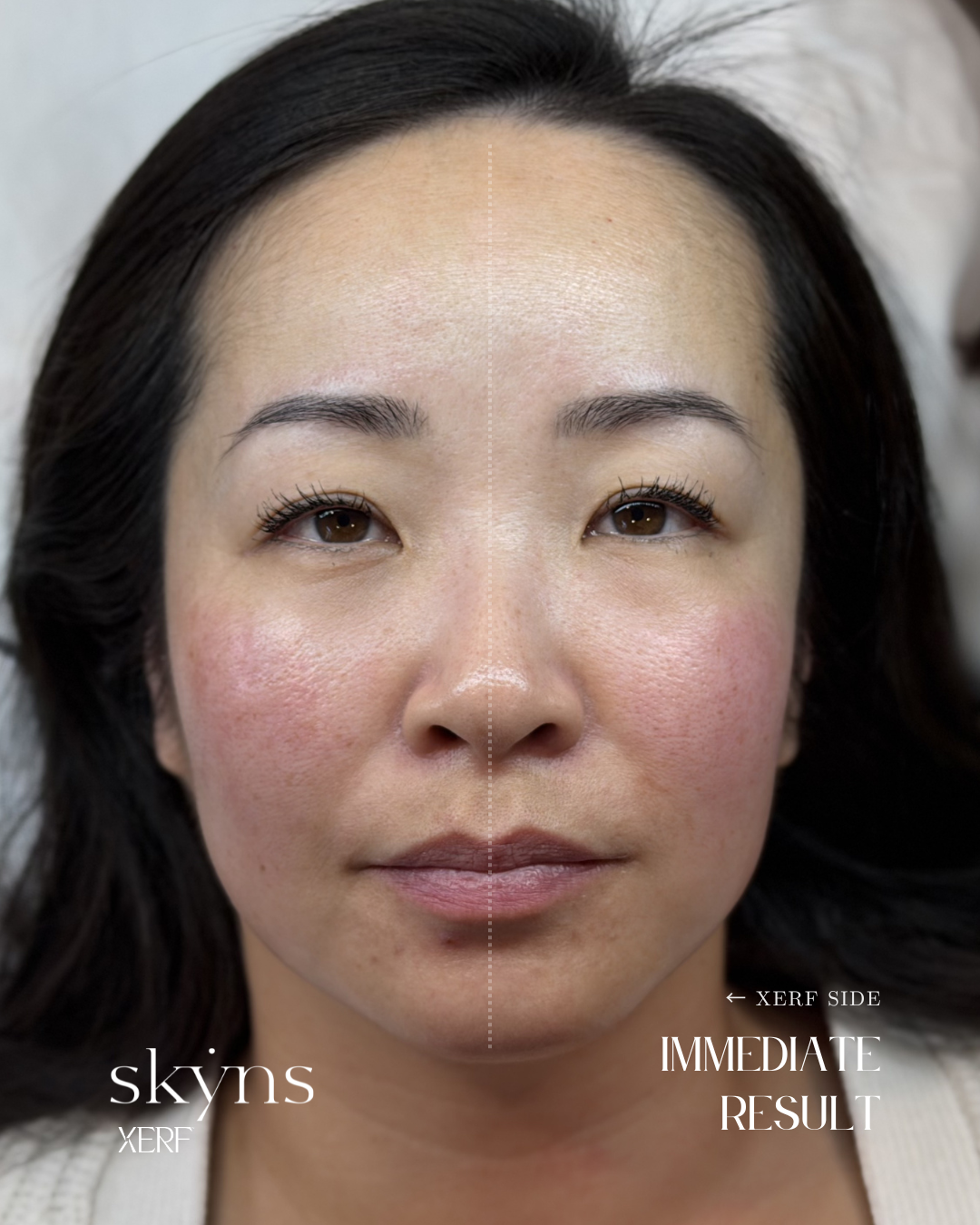 Immediate treatment response from XERF structural skin tightening technology.