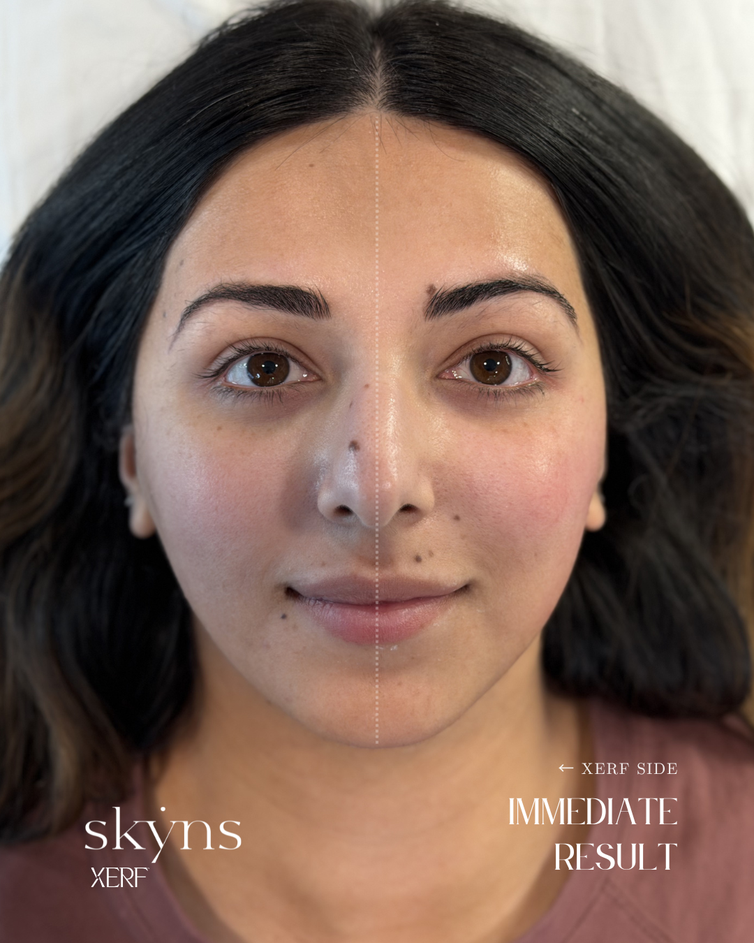 Immediate response following a personalized XERF structural skin tightening treatment.