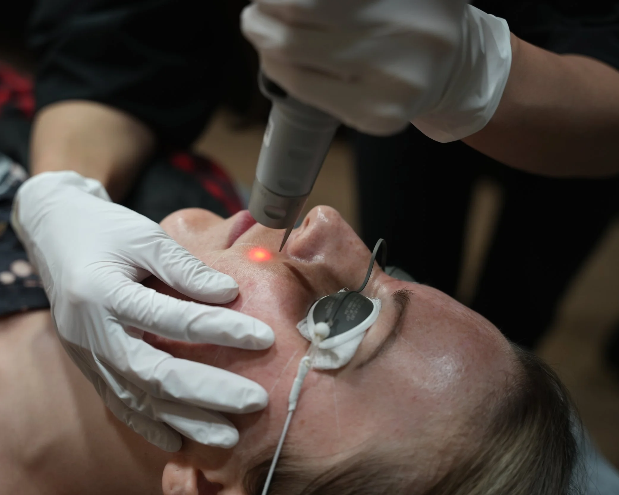 Client receiving a PicoSure Pro laser skin rejuvenation treatment for pigmentation and skin texture at SKYNS laser and skin clinic in Calgary.