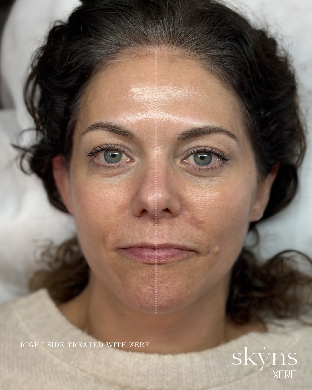 xerf-calgary-before-after-half-face-10.png
