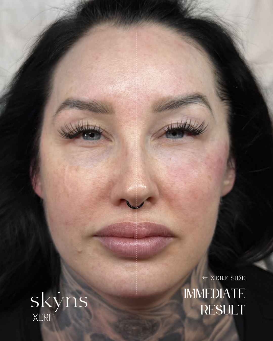 Immediate XERF treatment response highlighting improved facial support.