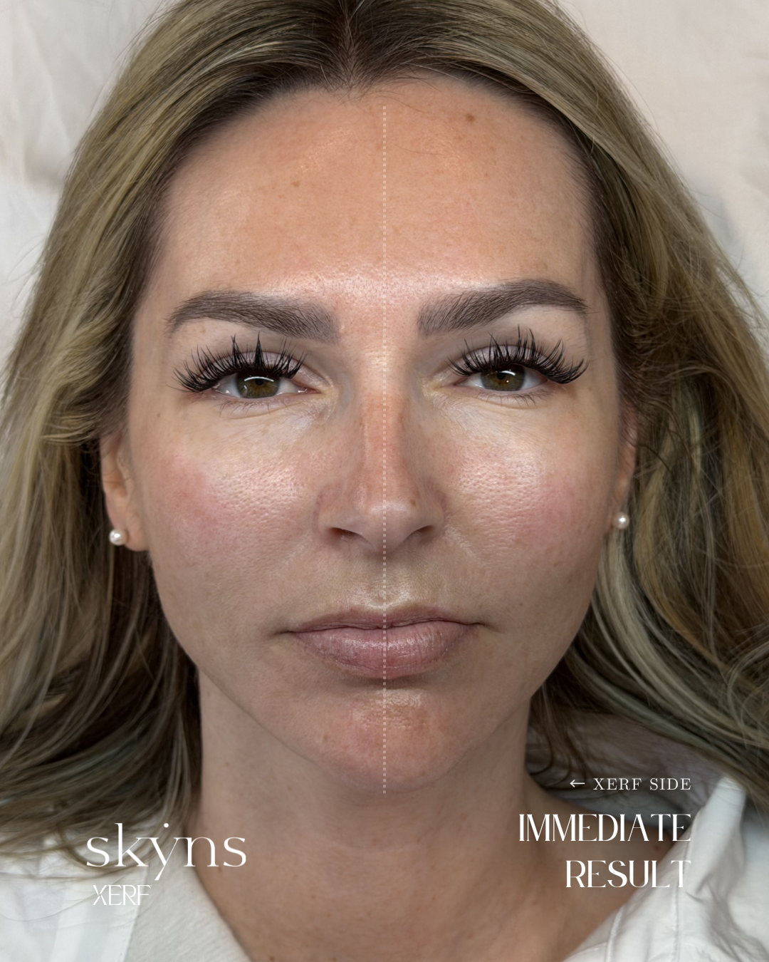 Clinical photograph following personalized XERF treatment.