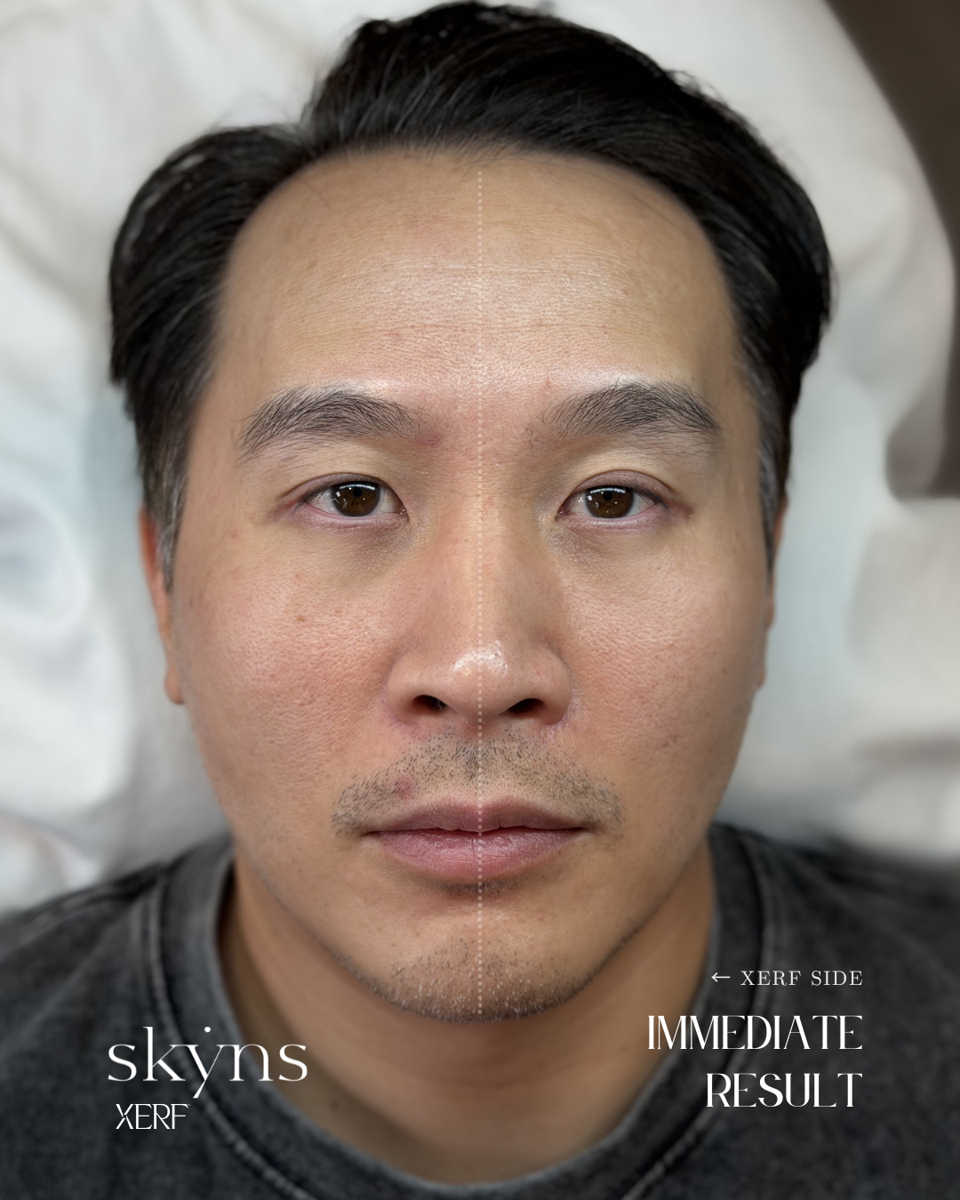 XERF structural skin tightening treatment supporting facial definition and contour.