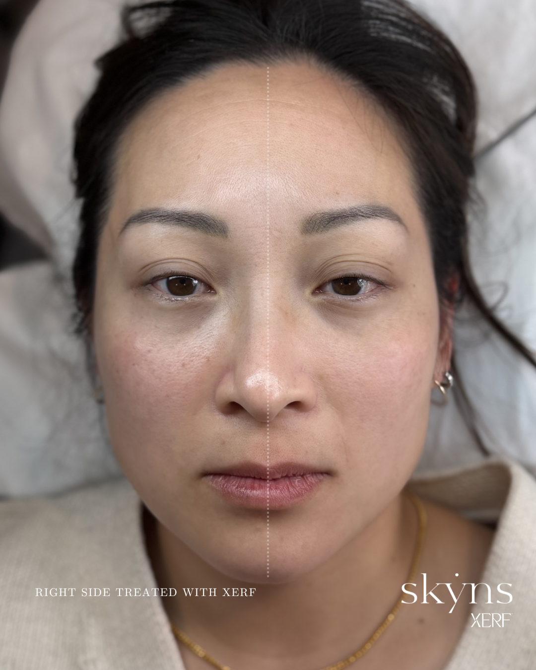 xerf-calgary-before-after-half-face-24.png