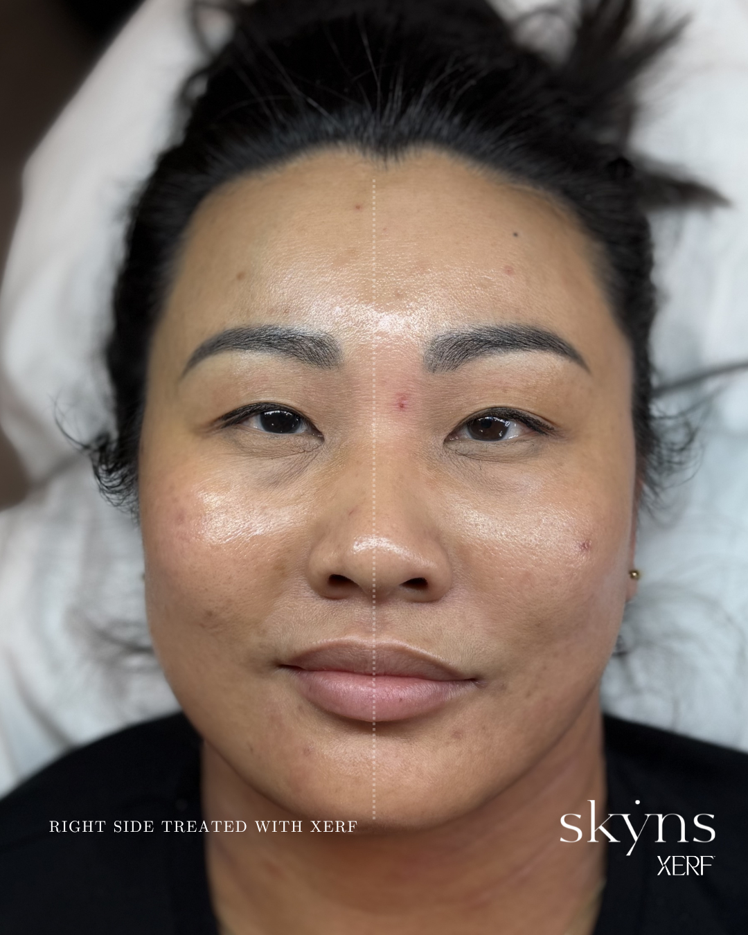 xerf-calgary-before-after-half-face-11.png