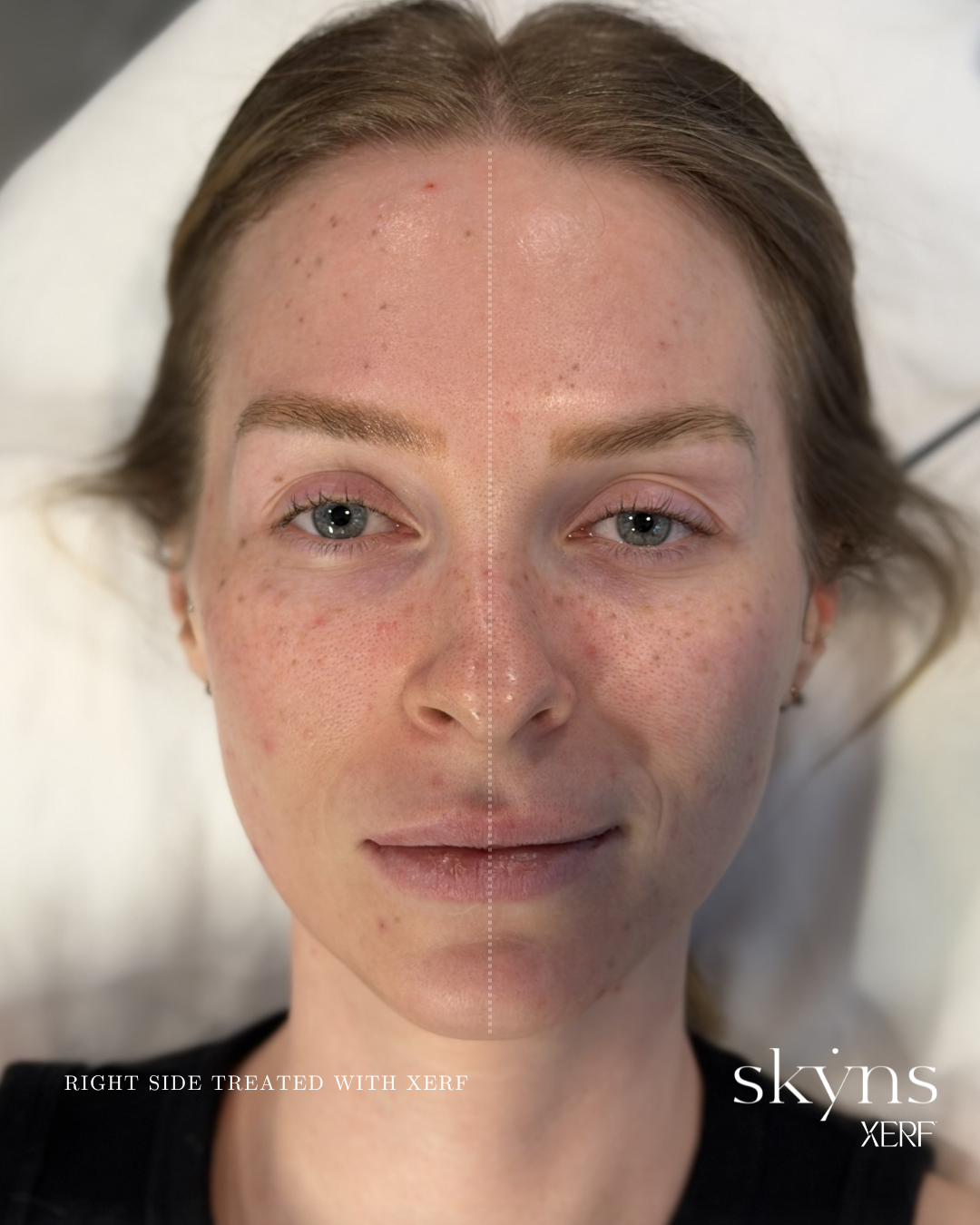 xerf-calgary-before-after-half-face-3.png