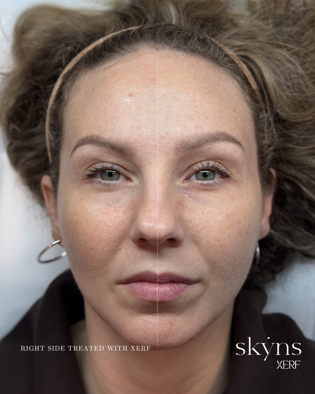 xerf-calgary-before-after-half-face-16.png