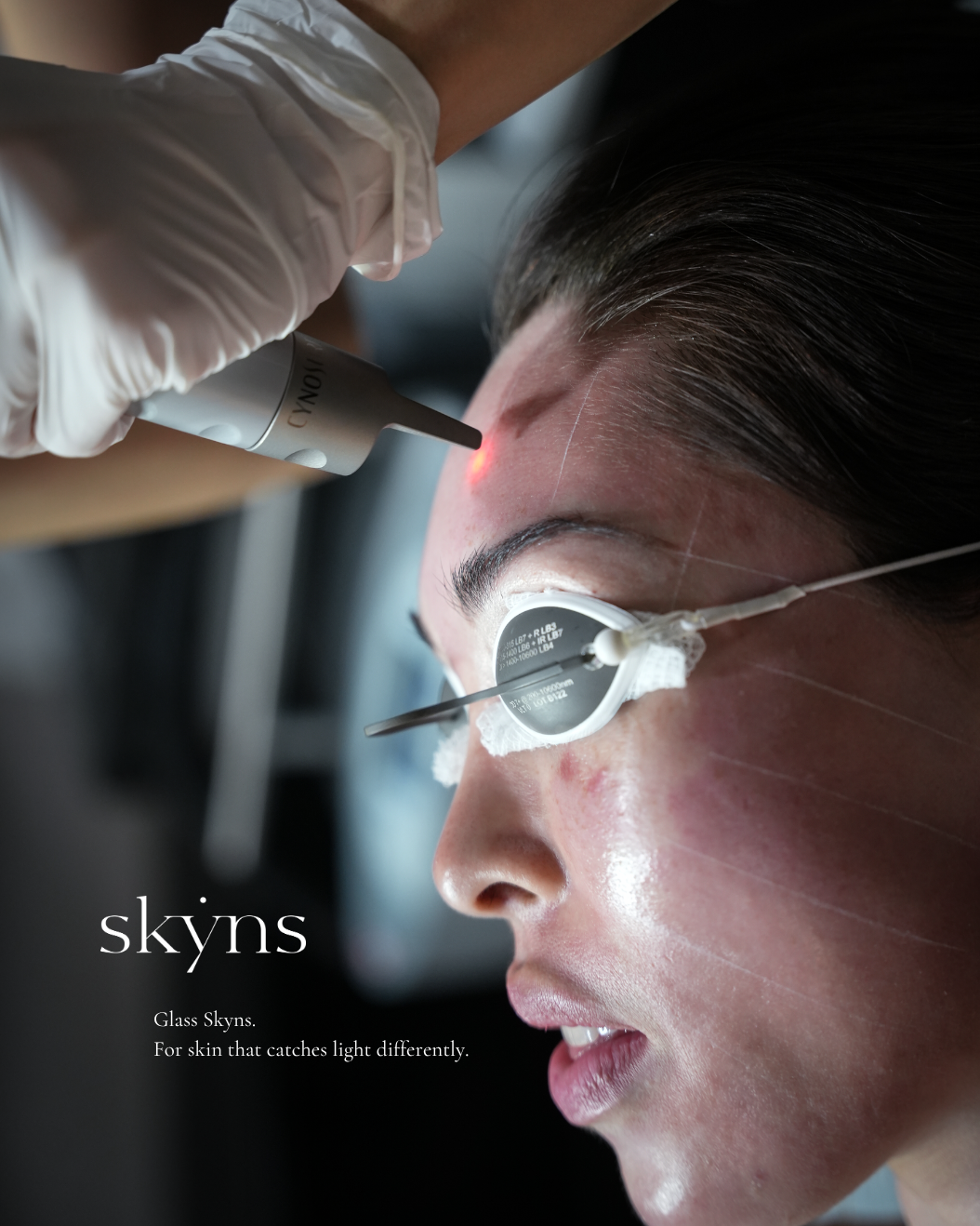 Client receiving a PicoSure Pro laser skin rejuvenation treatment for pigmentation and skin texture at SKYNS in Calgary.