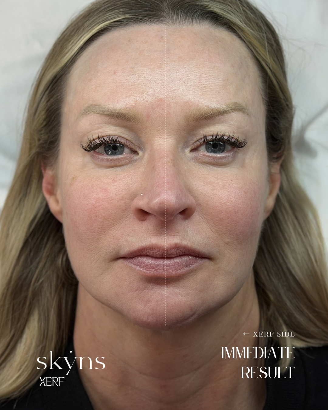 XERF structural skin tightening treatment demonstrating natural-looking support.