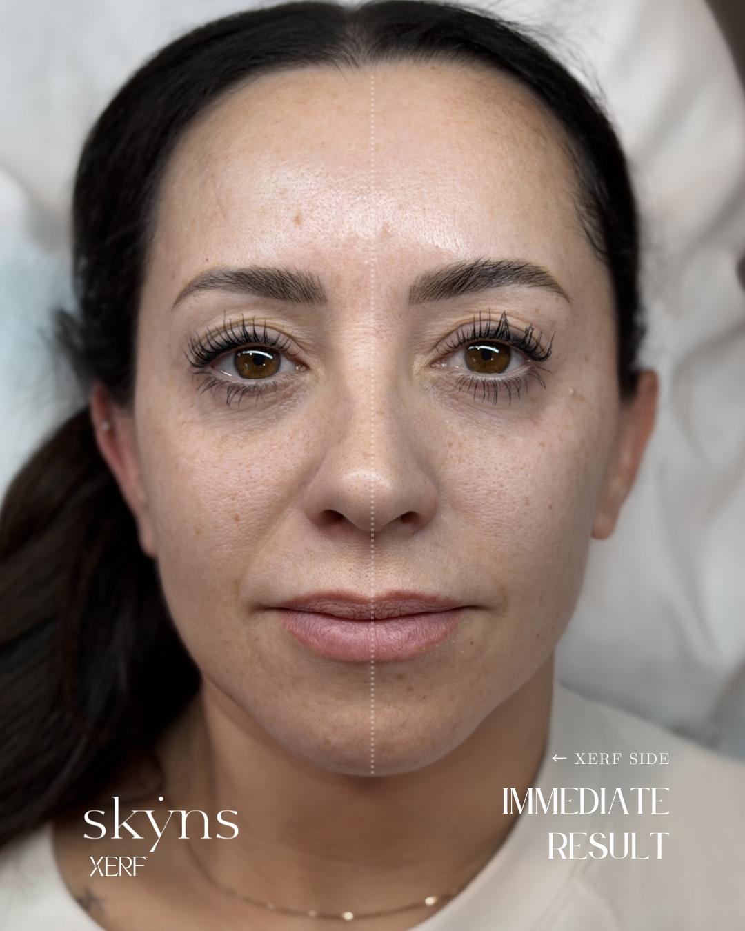 XERF treatment showing the treated side immediately after the procedure.