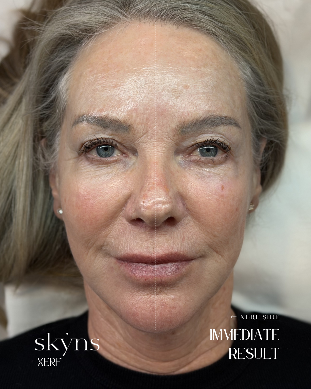 Clinical image showing one side immediately after XERF treatment.
