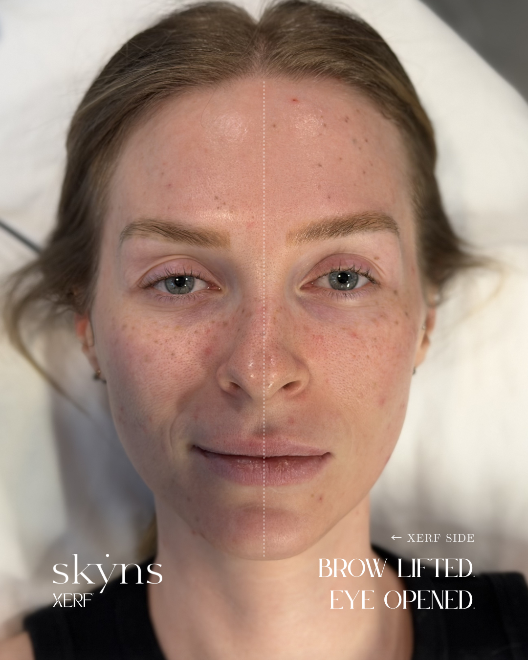 XERF structural skin tightening results
