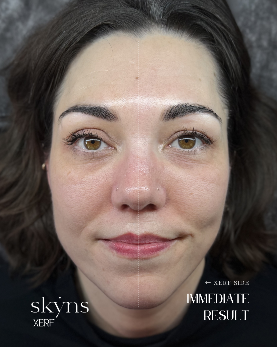 Real patient treated with XERF structural skin tightening technology.