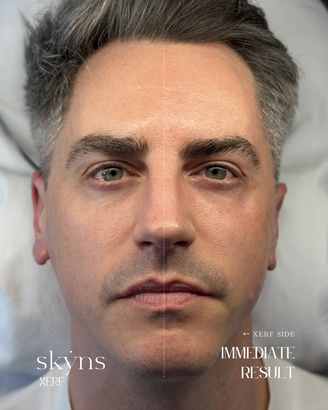 Personalized XERF treatment focused on structural skin tightening and facial support.