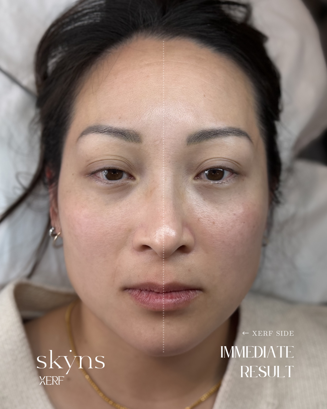 XERF structural skin tightening treatment demonstrating gradual tissue support.