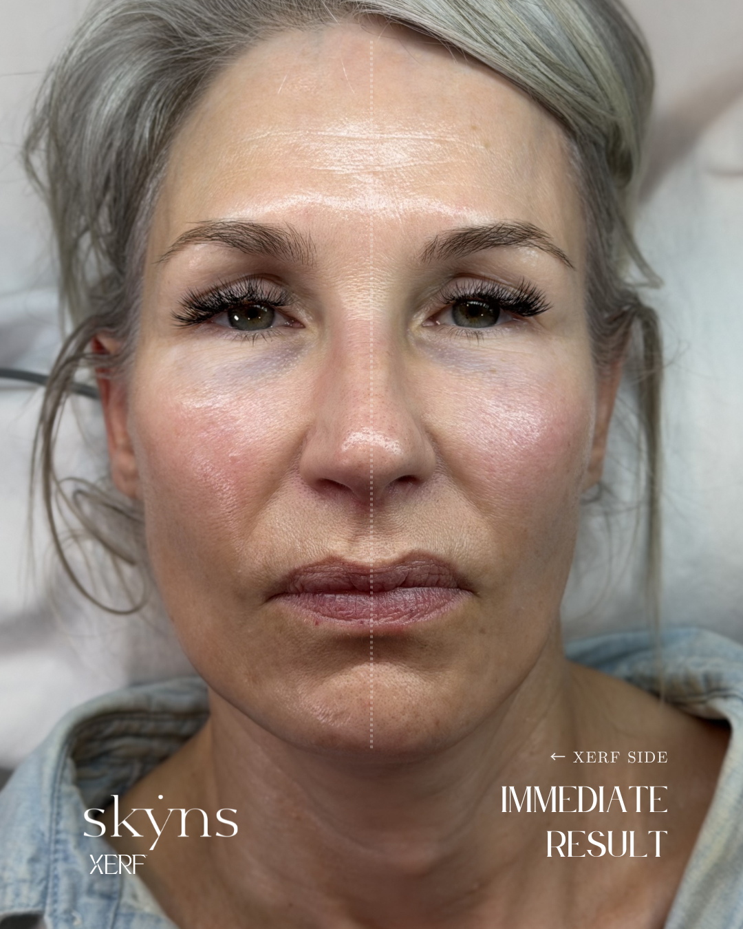 Half-face XERF treatment illustrating personalized structural skin support.